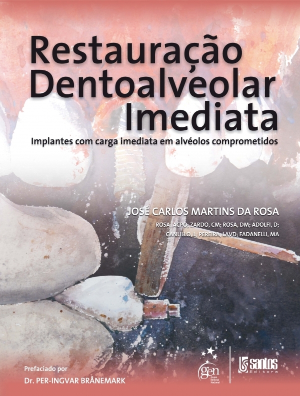 RESTAURAÇÃO DENTOALVEOLAR IMEDIATA IMPLANTES COM CARGA IMEDIATA EM ALVÉOLOS COMPROMETIDOS